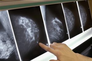 Lee más sobre el artículo Un nuevo fármaco multiplica la supervivencia en mujeres con cáncer de mama metastásico