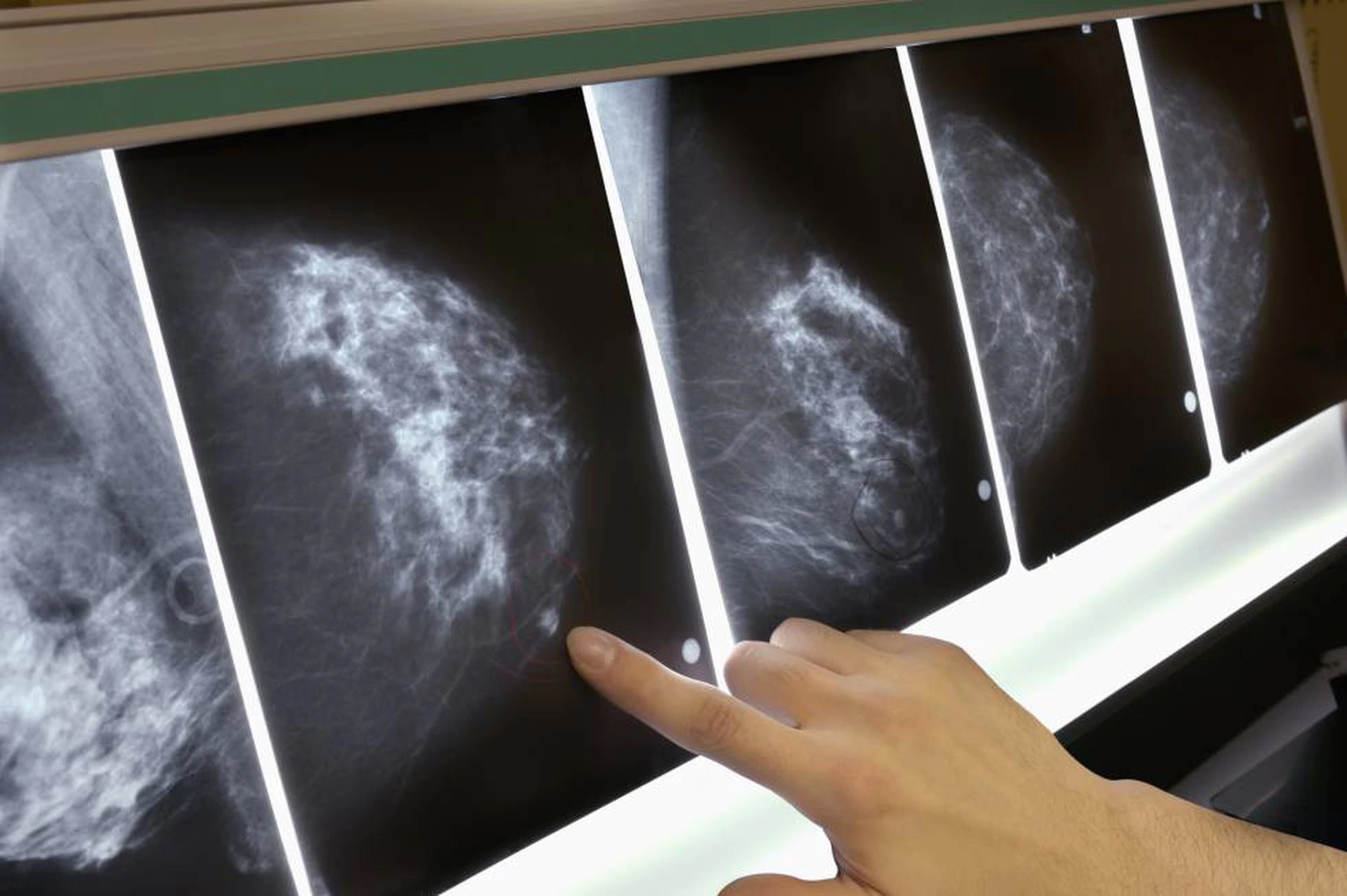 En este momento estás viendo Un nuevo fármaco multiplica la supervivencia en mujeres con cáncer de mama metastásico